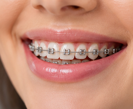 Orthodontic Treatment (Braces)