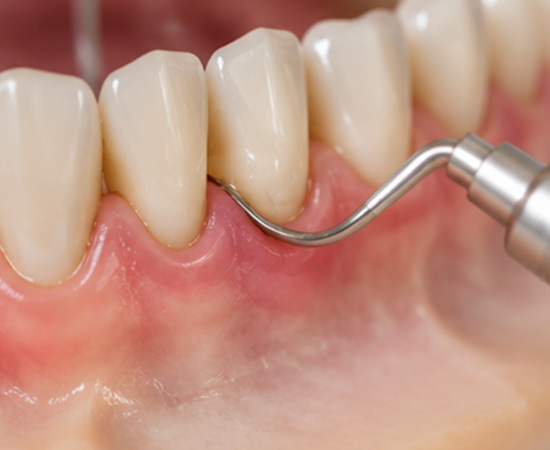 Root Canal